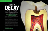 Tooth Decay - Dear Doctor Magazine